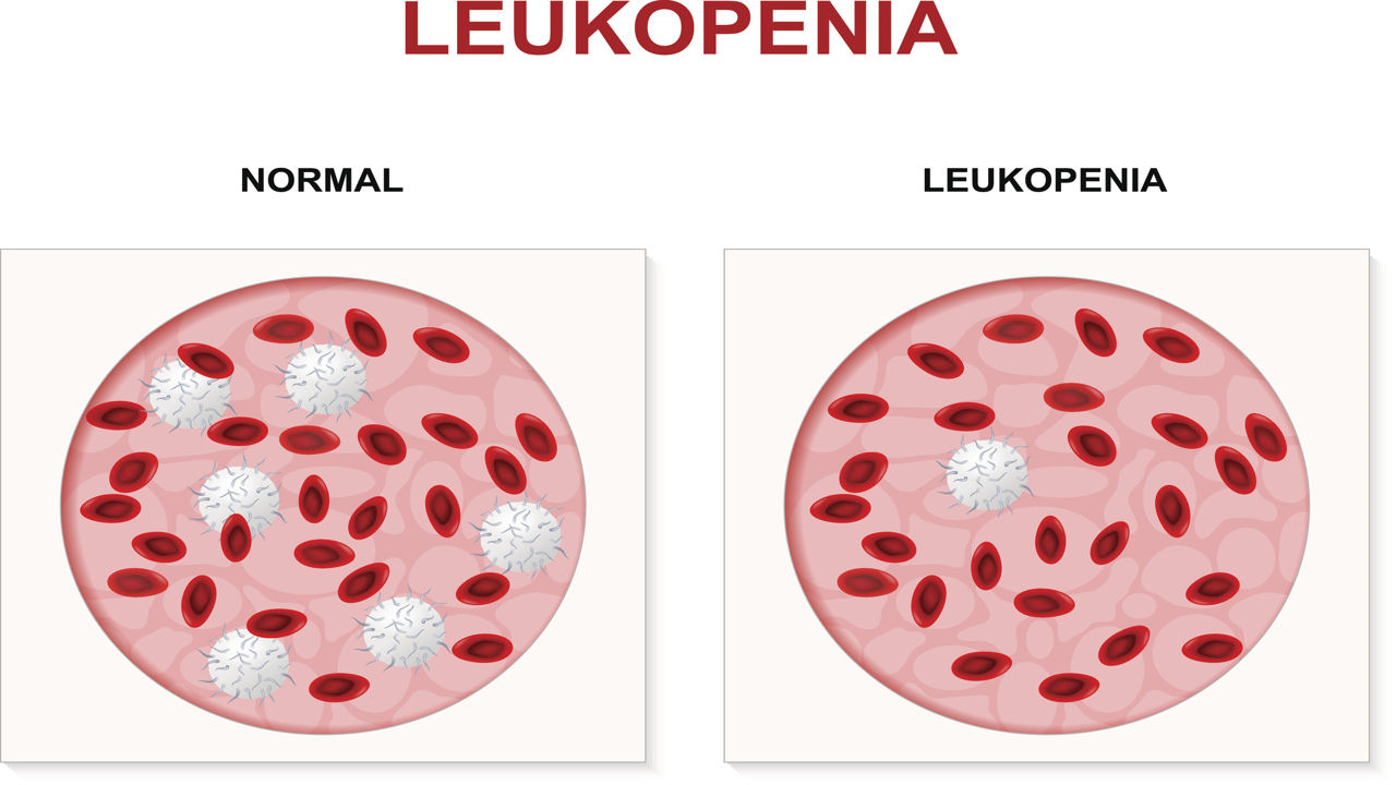 Symptoms and Treatment of Leukopenia