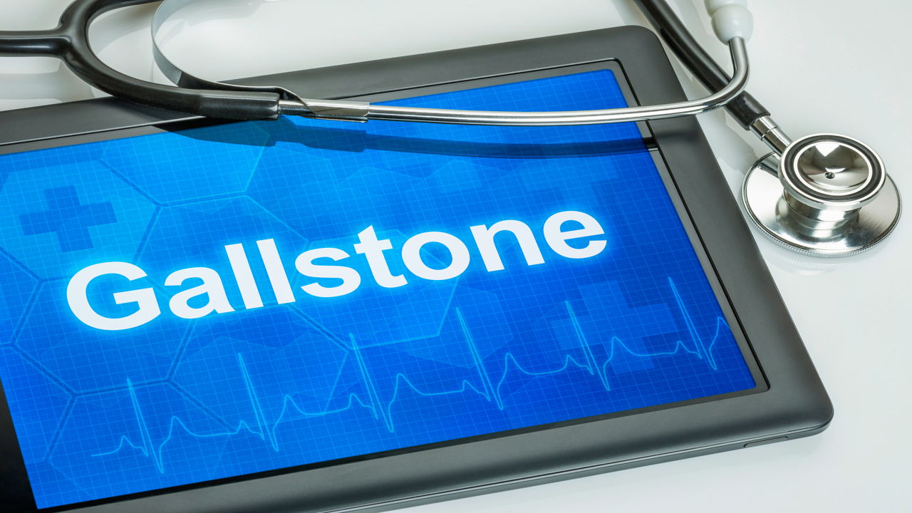Questions to Ask Your Doctor About Gallstones