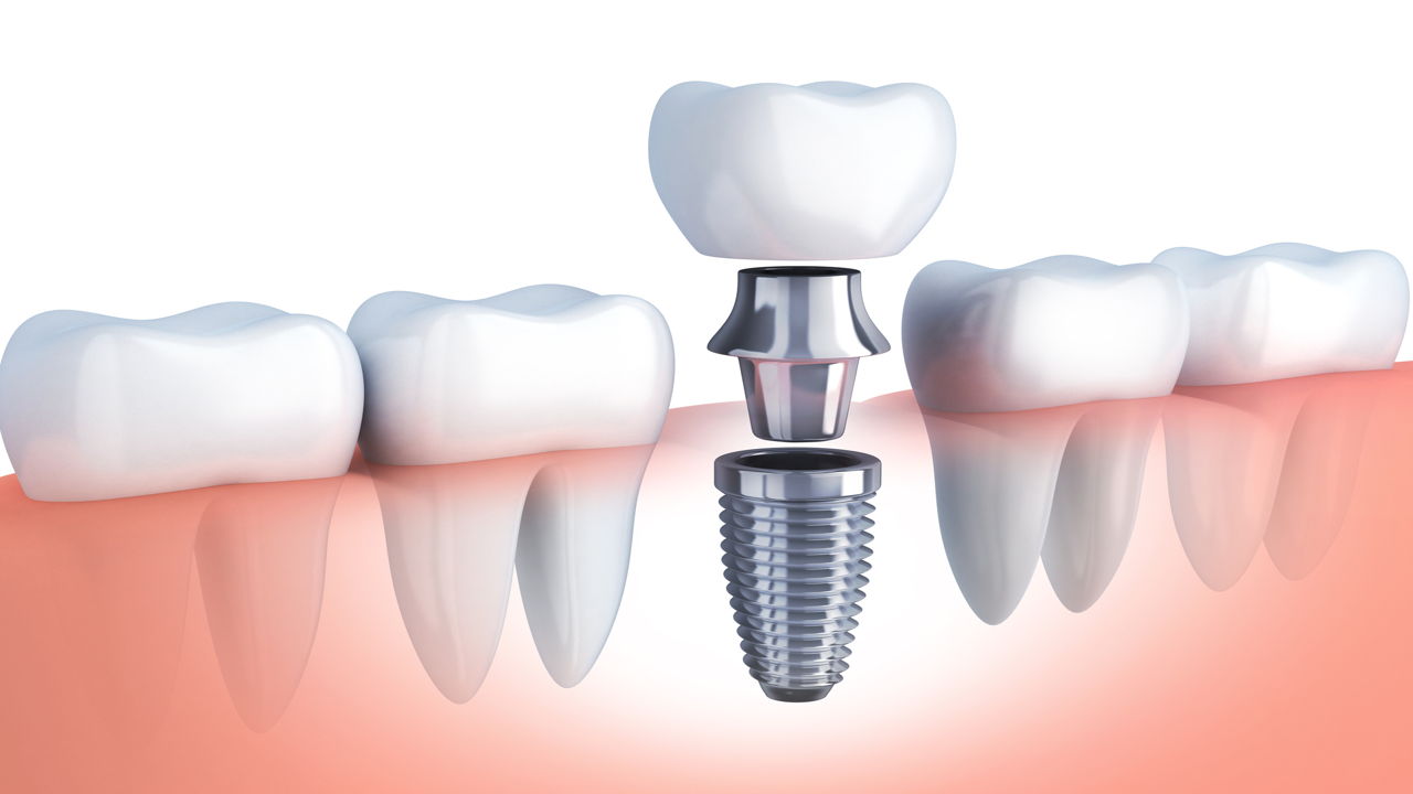 Dental Implants Average Cost