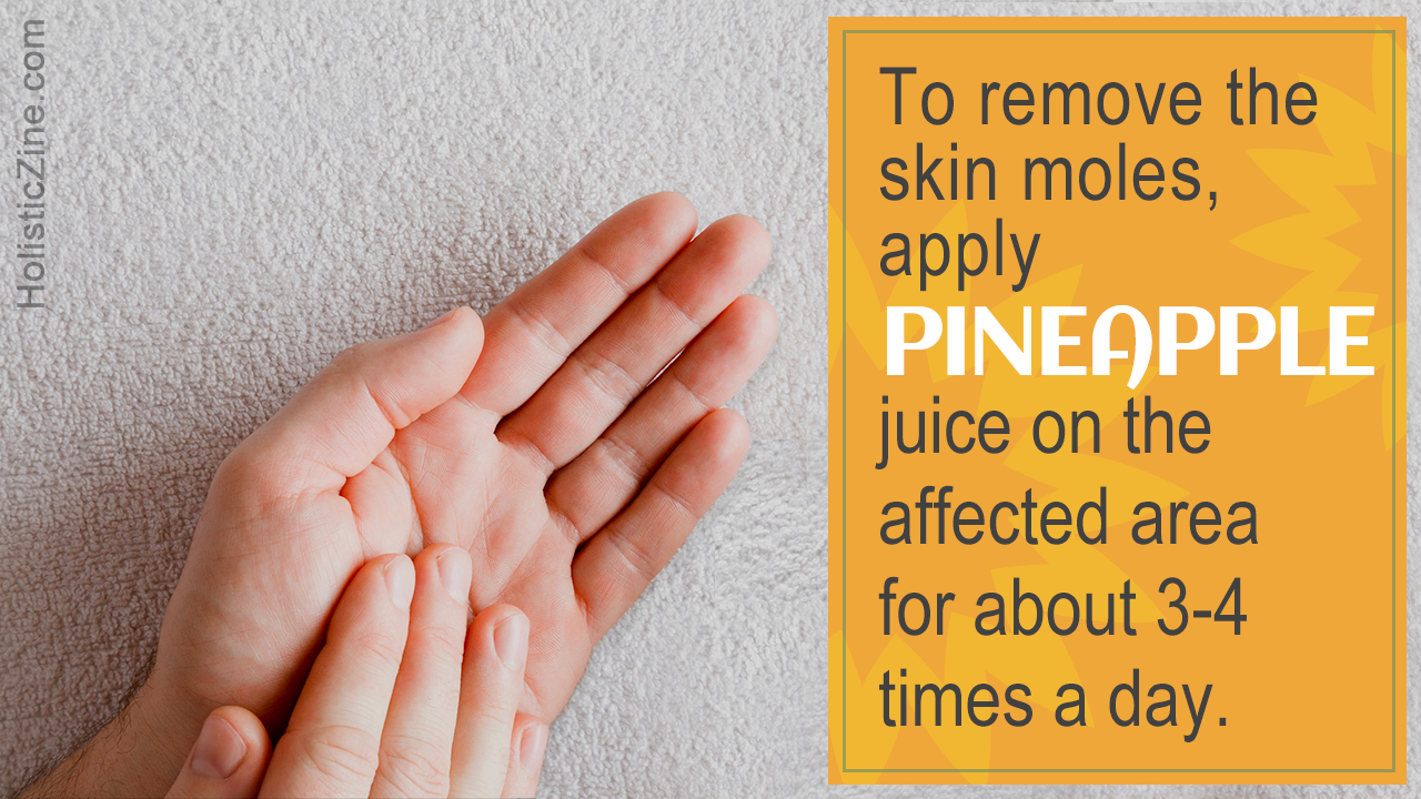 Home Remedies for Removing Skin Moles